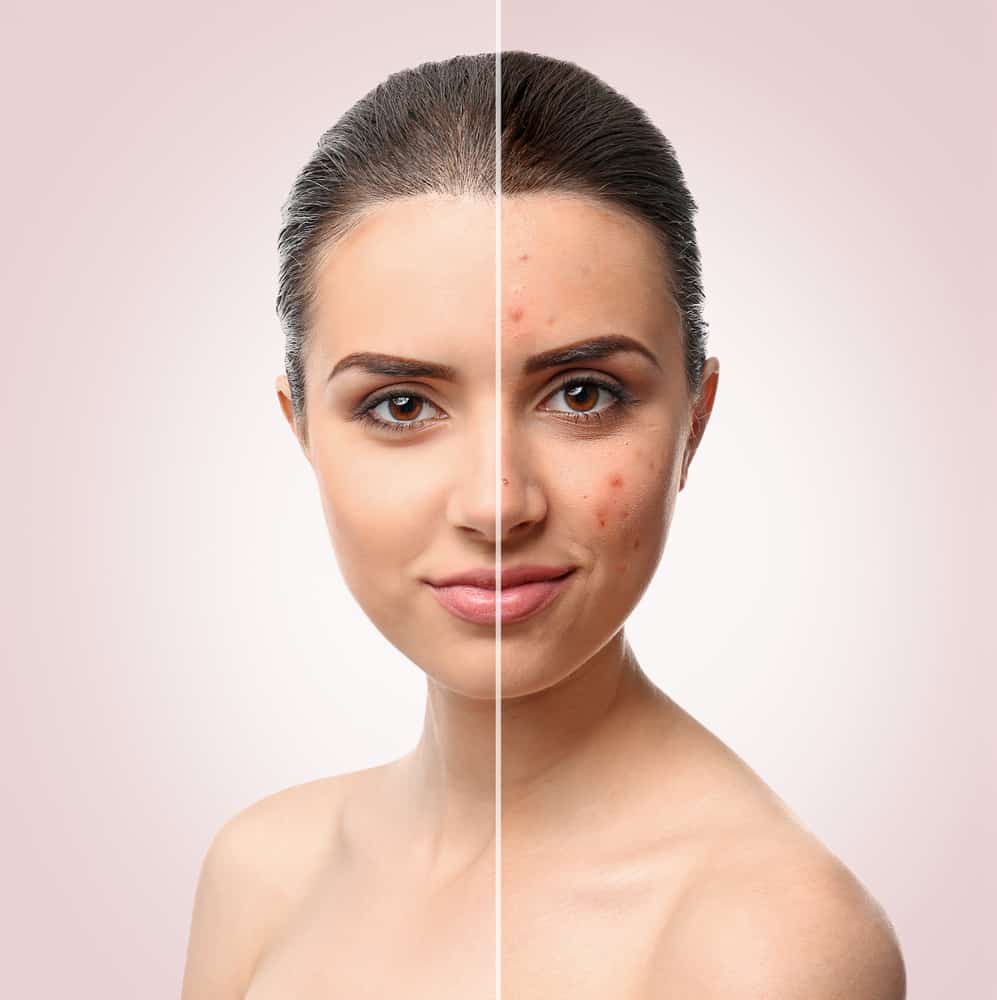 Facial anti-Acne