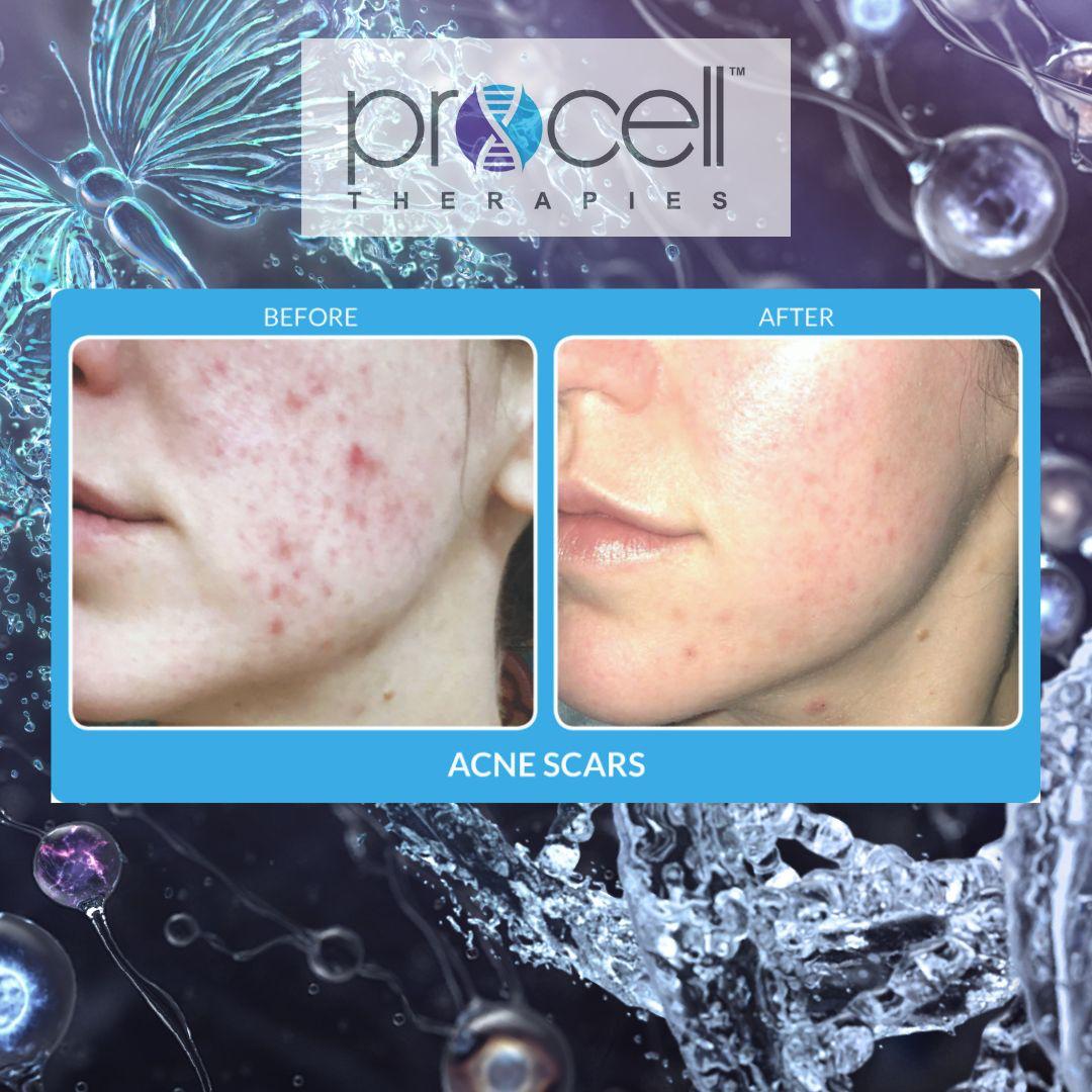 Procell nuevo tratamiento